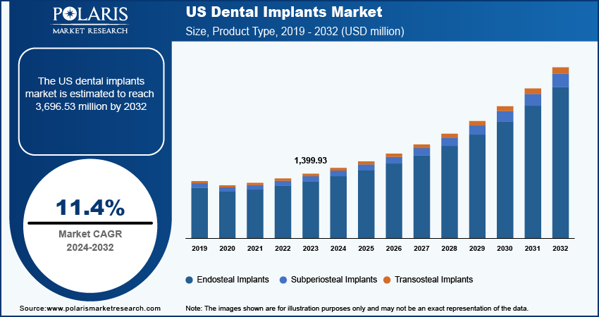 U.S. Dental Implants Market Size